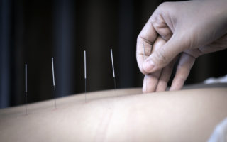 The physiotherapist is doing acupuncture on the back of a female patient. Patient is lying down on a bed.